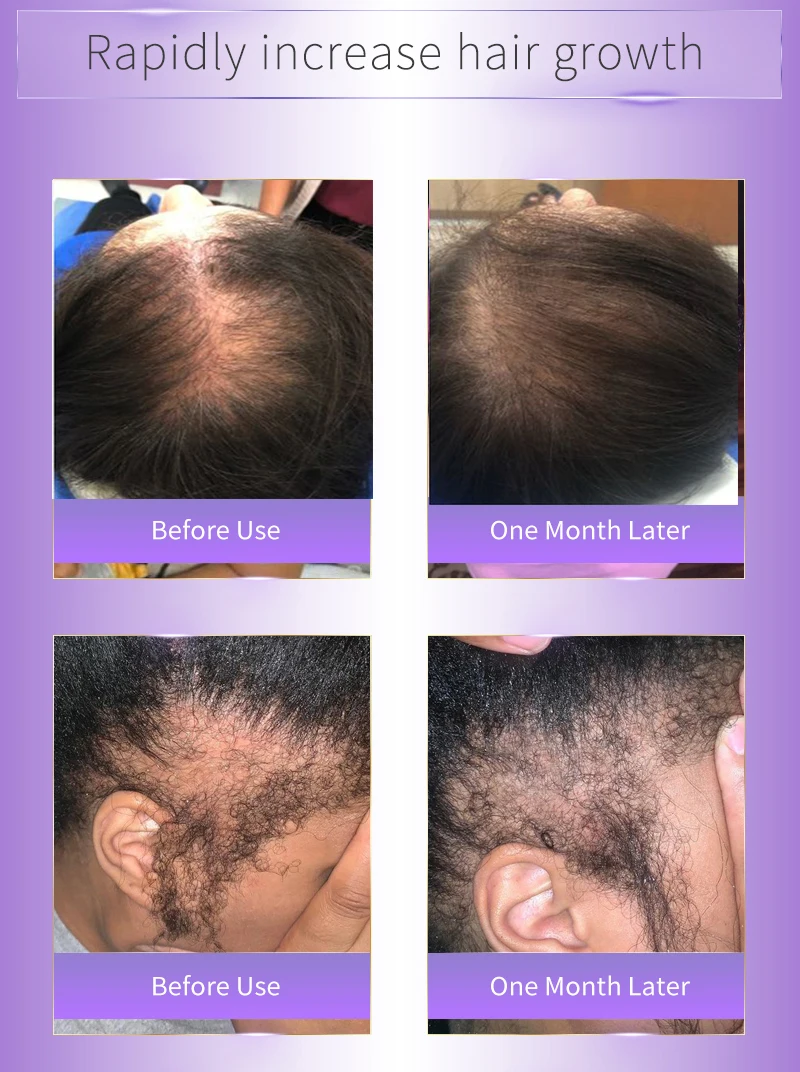 Customize Private Label Natural Essential Argan Oil Hair Loss Treatment Hair Growth Oil Growth Serum
