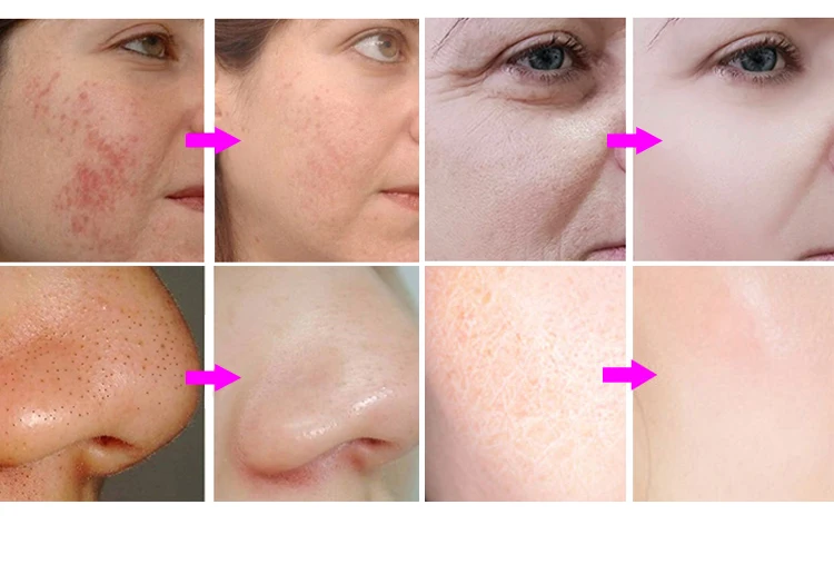 Hydro Dermabrasion Hydra Facial Machine Professional