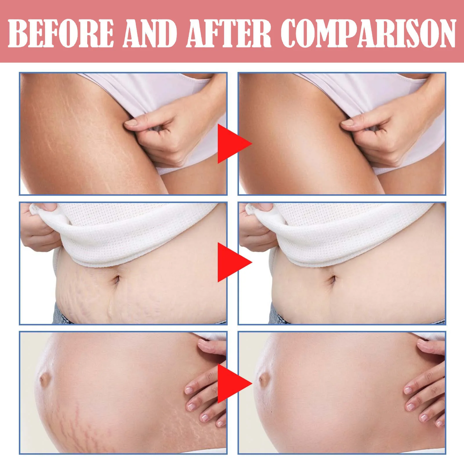 Hot Sale Vegan Stretch Marks Removal Cream Postpartum Body Care Repair Firming Stretch Marks Cream