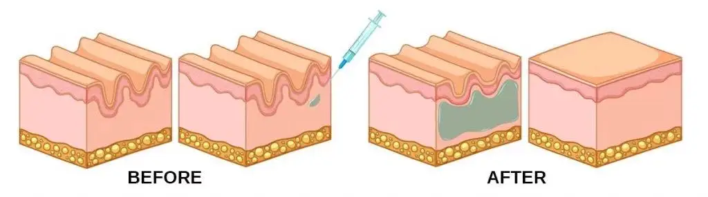 Hereme lips augmentation nose cheek HA gel injection cross-linked hyaluronic acid dermal filler for lip injections