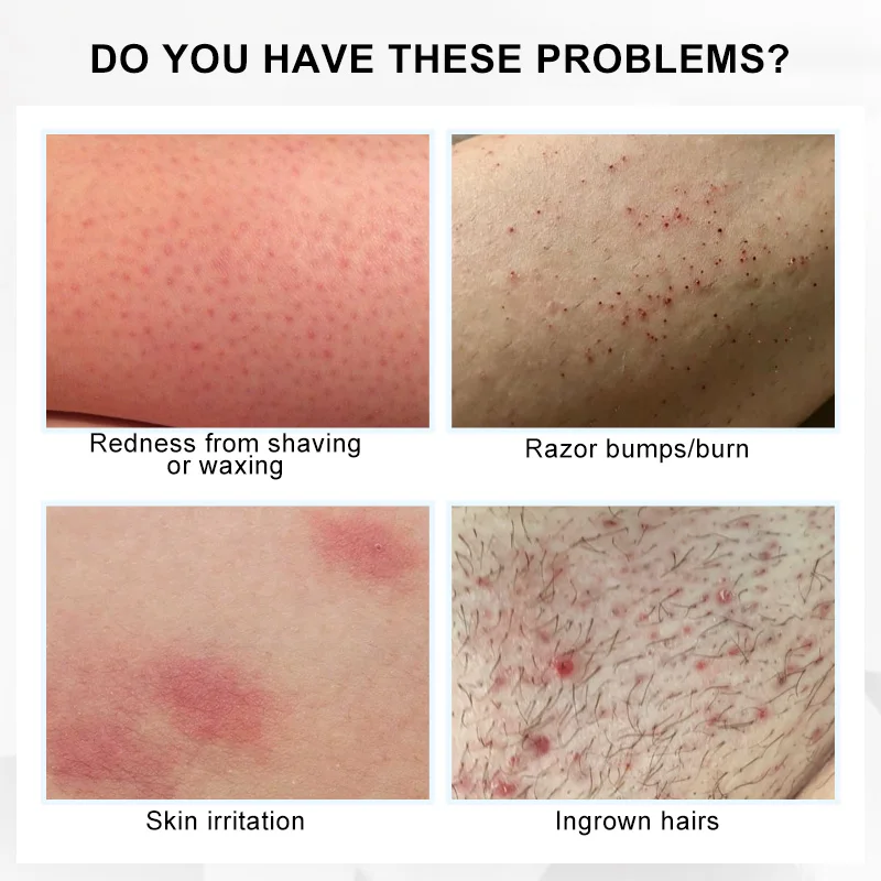 2023 Best Private Label Glycolic Salicylic Acid Ingrown Hair