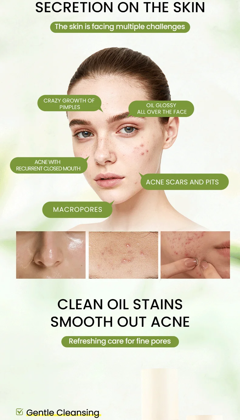 Icesea Australian Tea Tree Acne Solution Set - Daily Oil-Reducing Skincare Kit for Teen & Adult Acne, Clear Skin Essentials(pic2)