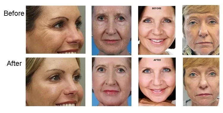 Factory Wholesale Price Hifu Cartridge Replacement 10000 Shots 20000 Shots  Wrinkle Remove Factory Price Hifu Cartridge