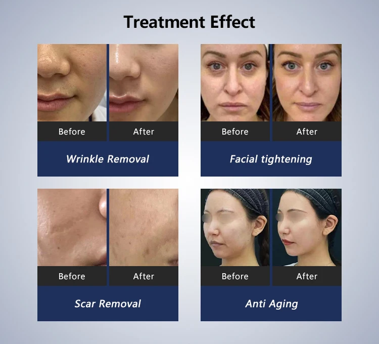 Skin Rejuvenation Radio Frequency Facial Lifting Reduce Fine Lines RF Microneedling Machine