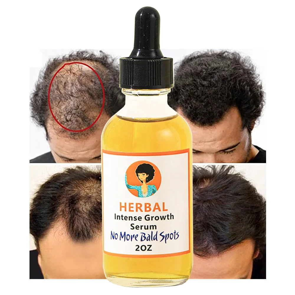 Results Guaranty In 30 Days Private Label Men Hair Loss Treatment Biotin  Hair Growth Serum Oil - Buy Hair Growth Oil,Hair Growth Vitamins Private  Label,Hair Growth Product Product on 