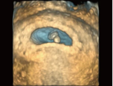 Sonoscape P20 Mobile 3D/4D Real-time Color Panoramic Doppler Trolley Ultrasound Machine supplier