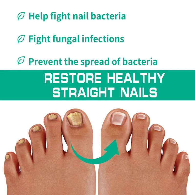 20g nail fungus ointment bacterial fungal relieving nail nourishing repair cream