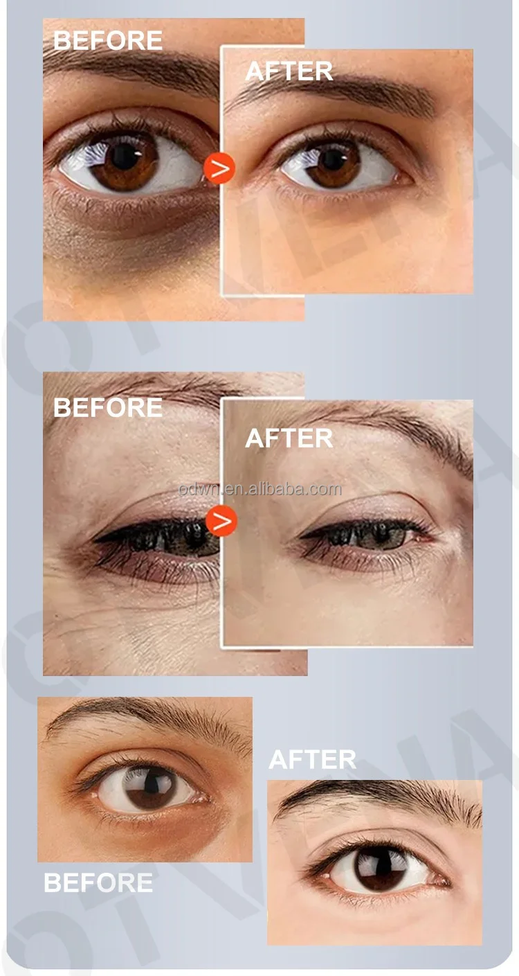 OTVENA Syringe Instant Tightening Wrinkle Eraser Eye Cream Face Lift  Wrinkle Skin Care Eye Cream