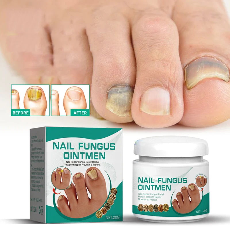 20g nail fungus ointment bacterial fungal relieving nail nourishing repair cream