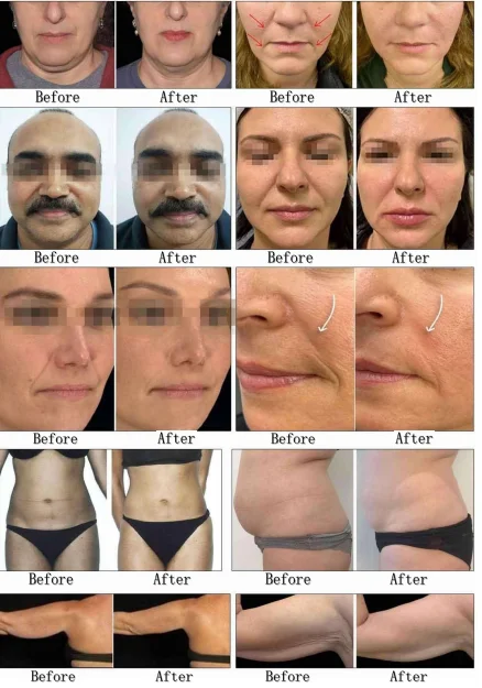 12D RF Frozen Hifu Machine for Wrinkle Removal Body Slimming