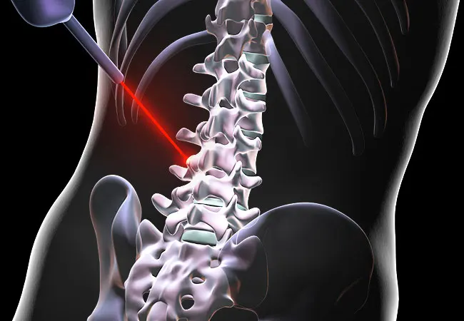 LASER-SPINAL-SUGERY
