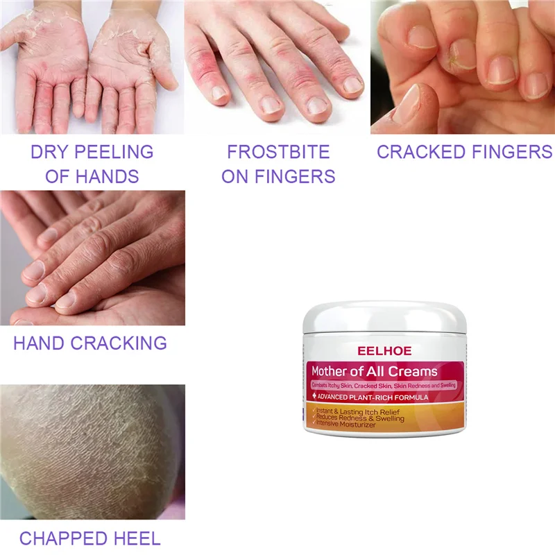 Eelhoe Mother Of All Creams Itchy Cracked Red Swelling Skin Dry Peeling