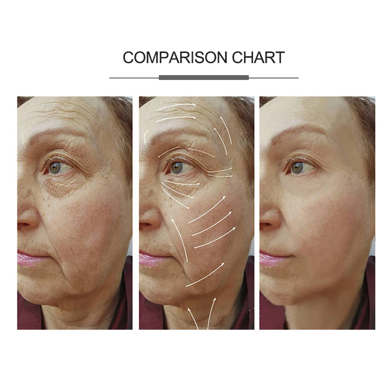 これにより 2022年高販売痛みのない肌の再生2プローブフェイスリフティングアンチエイジングエクササイズアップル筋肉高rfマシン家庭用