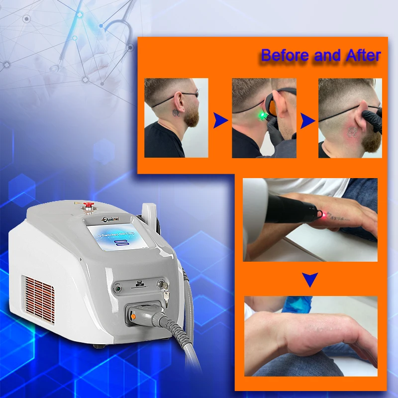 Factory Q-switch Nd Yag Pico Laser Tattoo Removal 1064 532 nm Beauty Instrument Machine