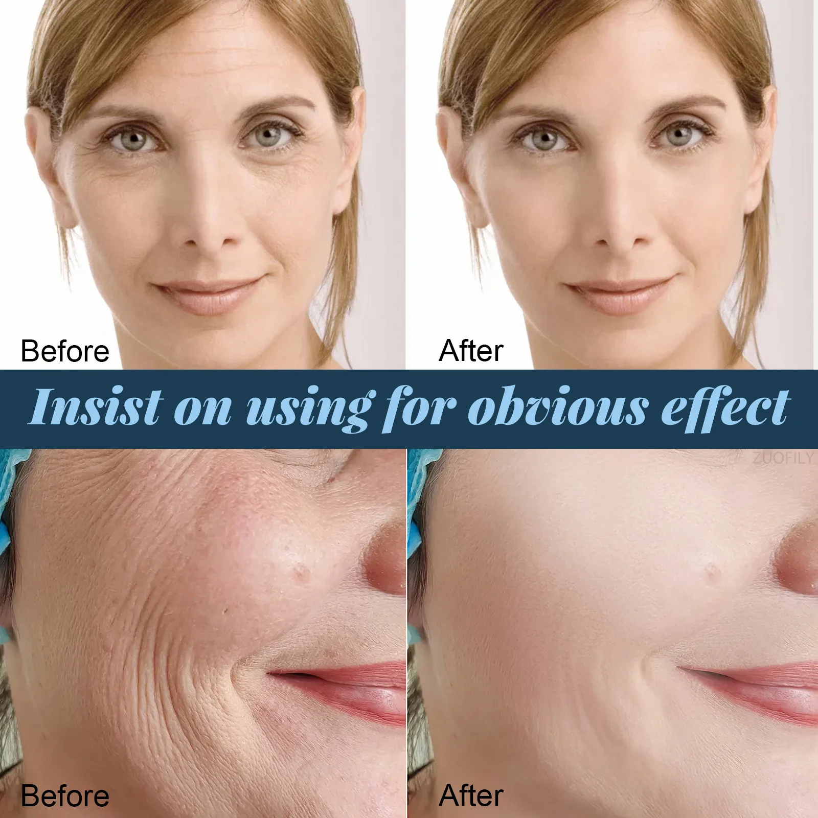 Collagen radar Silk Protein Line Thread Face Lifting Lifts Tighten Collagen Water Soluble 24K Serum No Needle for Anti-aging