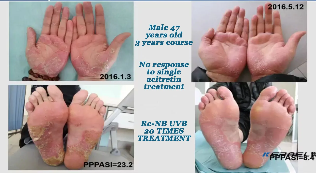 Kernel Medical 311 Nm Nb Uvb Vitiligo Phototherapy Device Of 368nm Uva Light Therapy Lamps Uvb