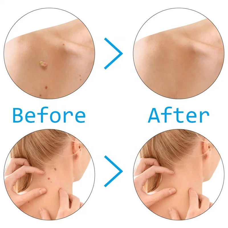 Home Use Low Price Skin Tag Remover Kit to Removal Skin Tags Body Effective Mole Wart Removing Skin Tags