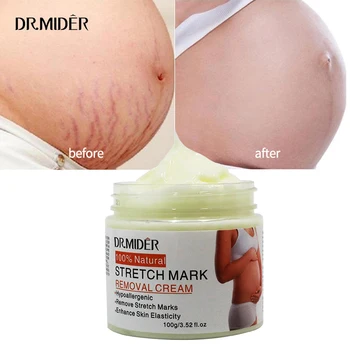 High Quality Powerful Stretch Marks Remover Skin Repair Cream Treatment Scar Removal Pregnancy Cream Adults GMP Moisturizer 1pcs