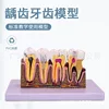 Dental caries model