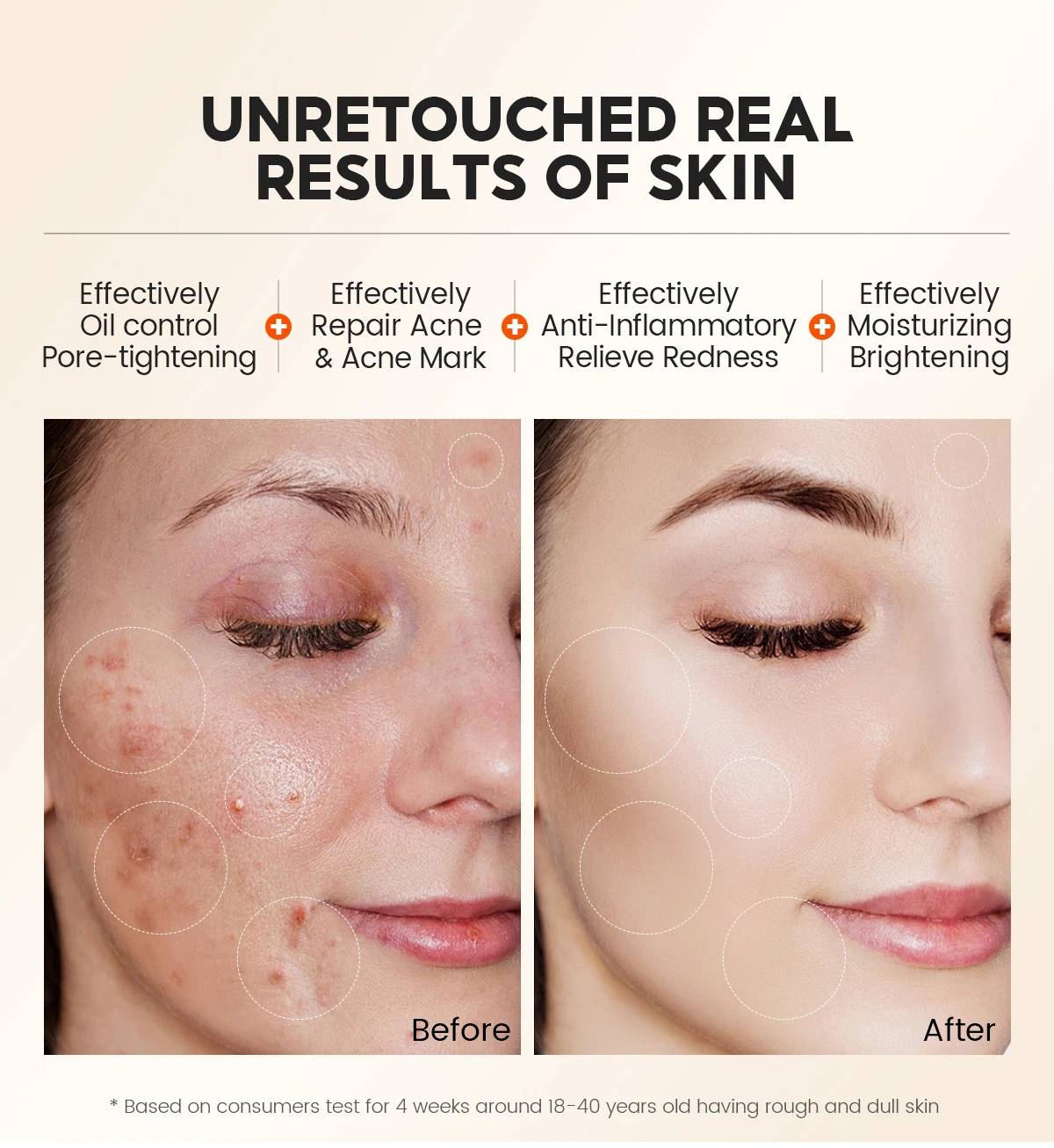 Vibrant Glamour AHA+BHA 1% Face Nose Acne Remove Mask Gentle Cleansing Exfoliating for Oily & Acne-Prone Skin Salicylic Acid