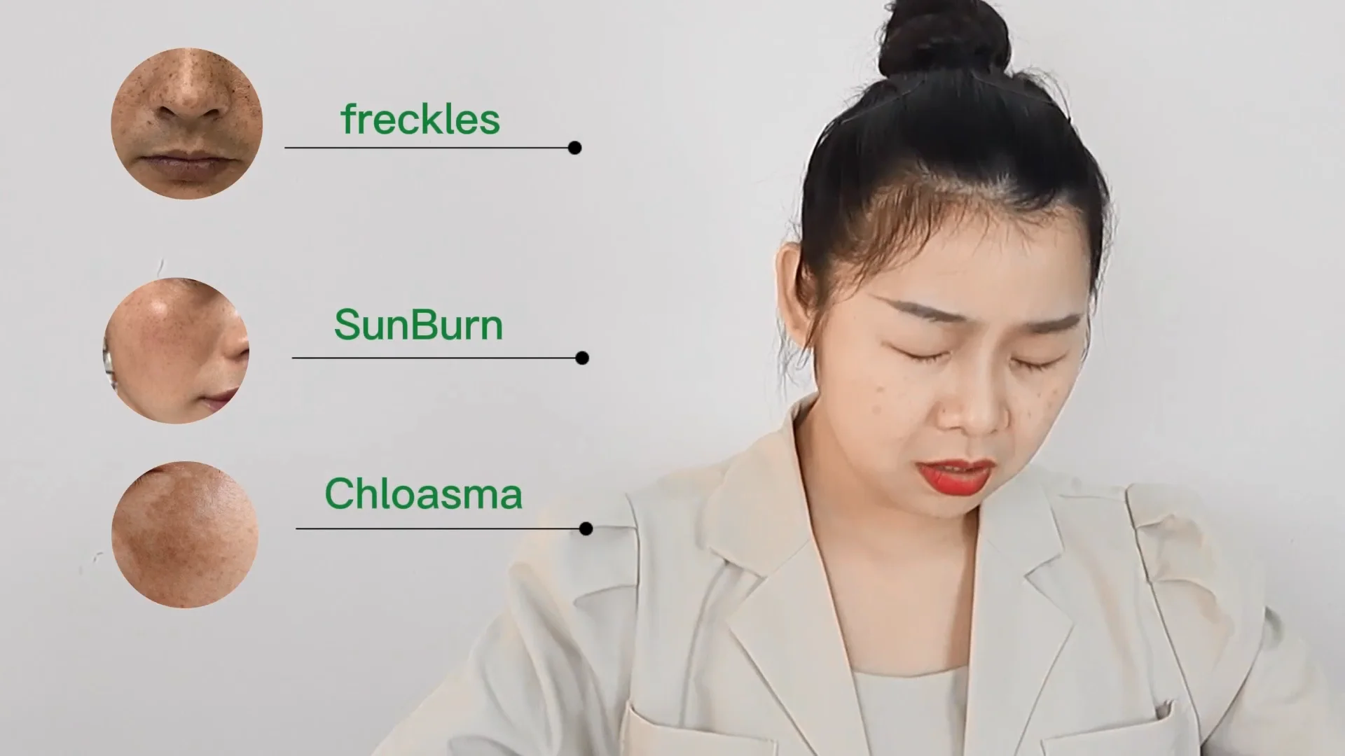 Pimples Melasma Blemish Removal Dark Spot Remover Cream Strong