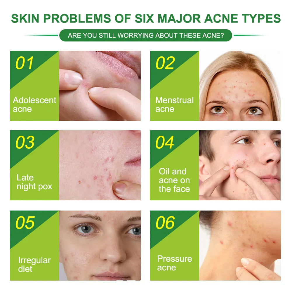 New Skin Care Hydrocolloid TeaTree Extract Treatment Acne Removal Plaster Master Pimple Acne Patch