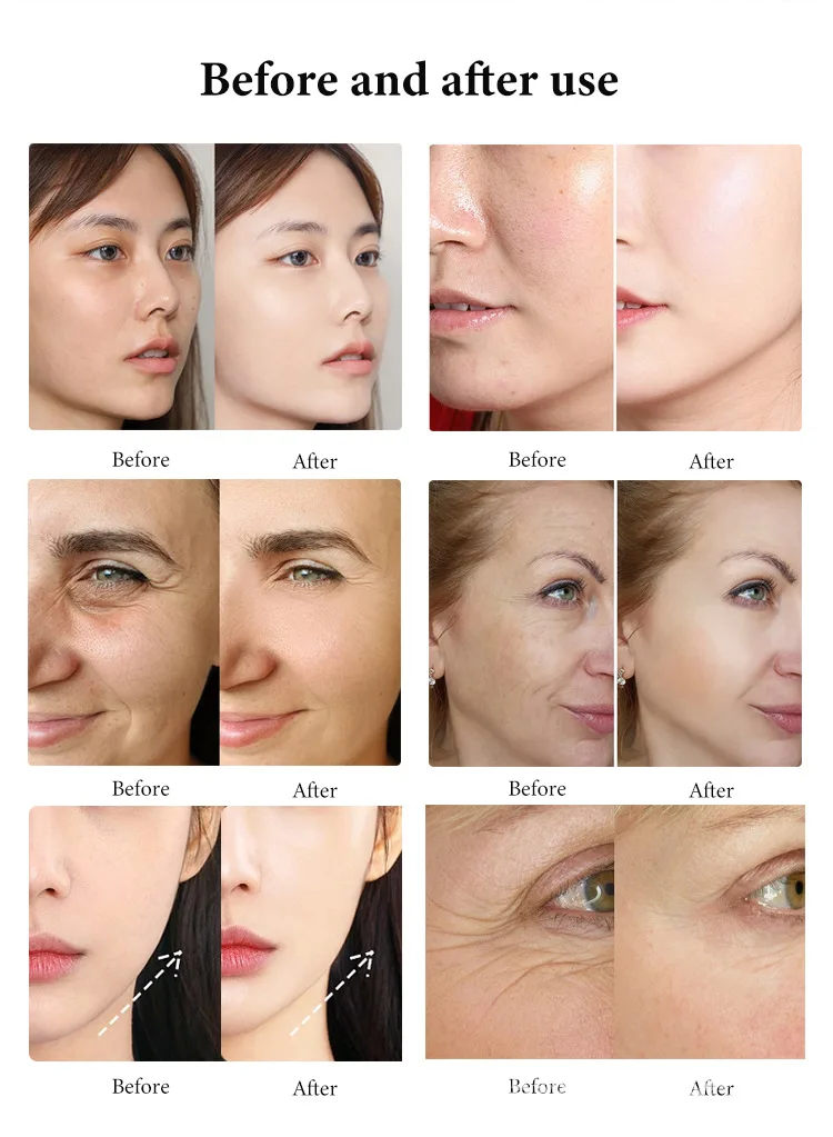 4-in-1 Oxygen Facial Machine with RF, Ultrasonic & Skin Analyzer 9 Newest 4 in 1 Oxygen Bubble Oxygenation Face Lifting Device Skin Tightening Facial Jet Peel Bubble Machine