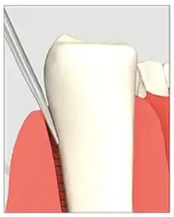 Tiantian Dental Double Ended Elevators - Sinus Lifting Tools