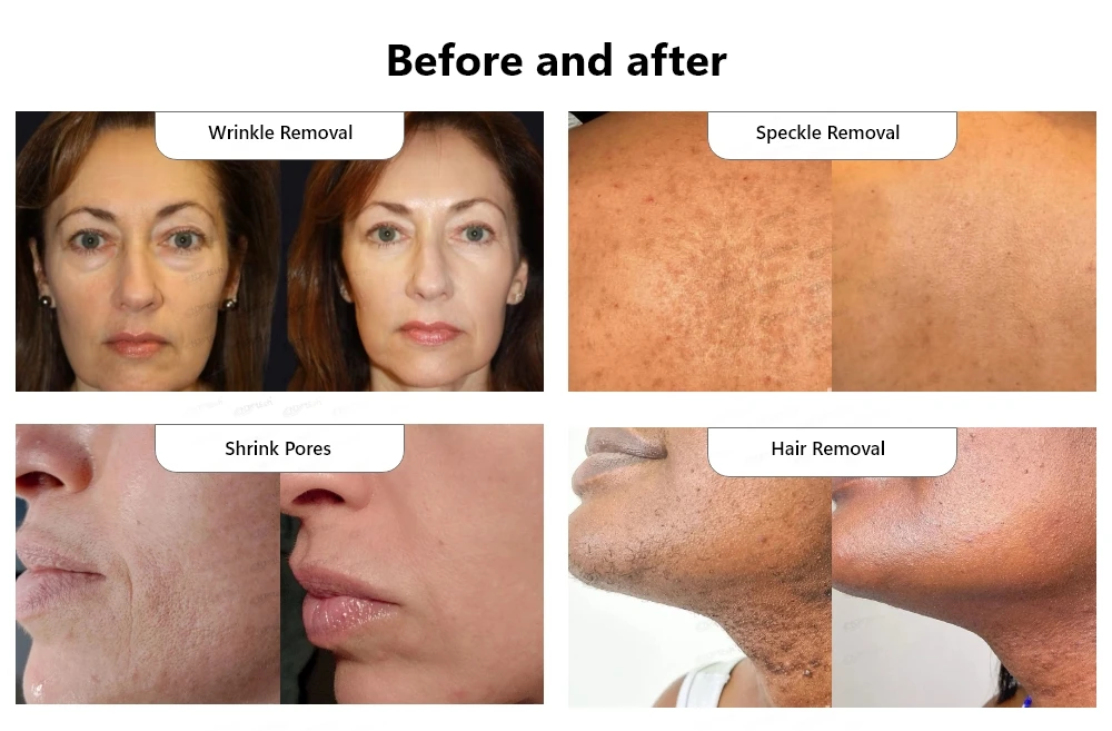 Melanoma Depilacion Laser Cancer De Piel Depilación Láser Diodo De