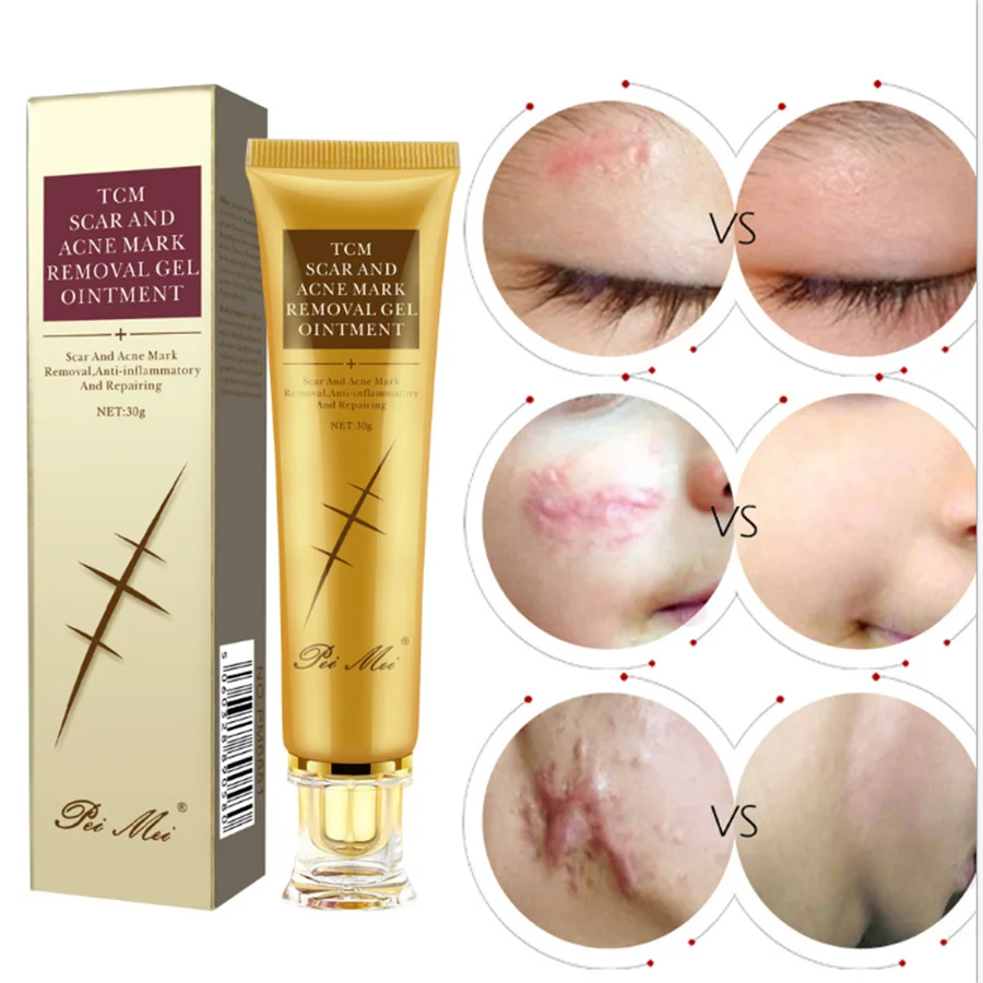 acne spot removing cream