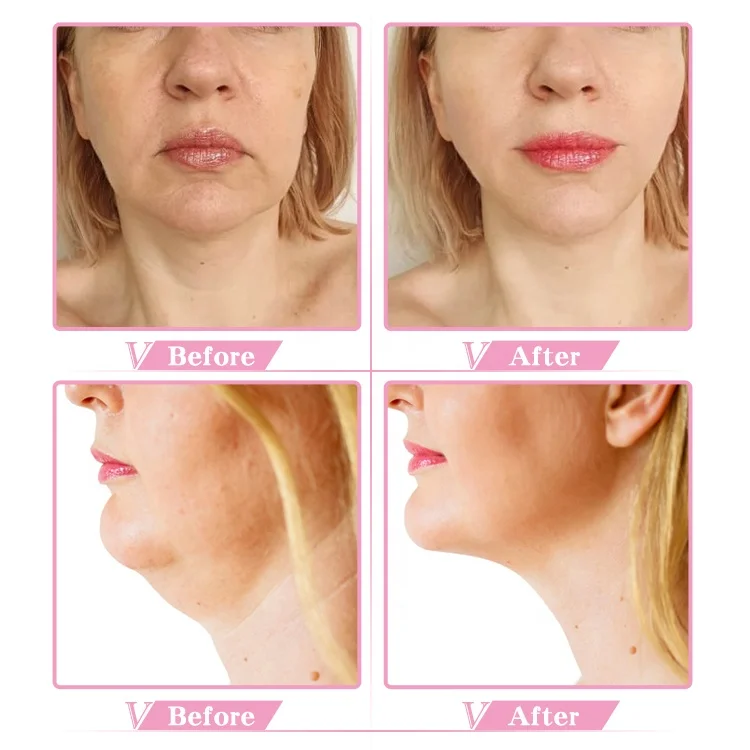 face slimming strap face lift double
