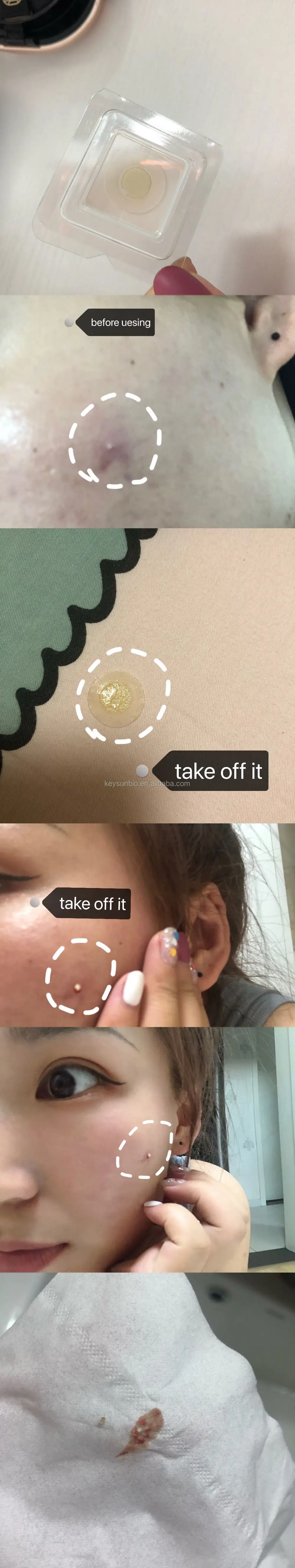 ks484 needle acne patch 