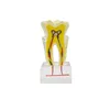 6 Times Molar Tooth Model