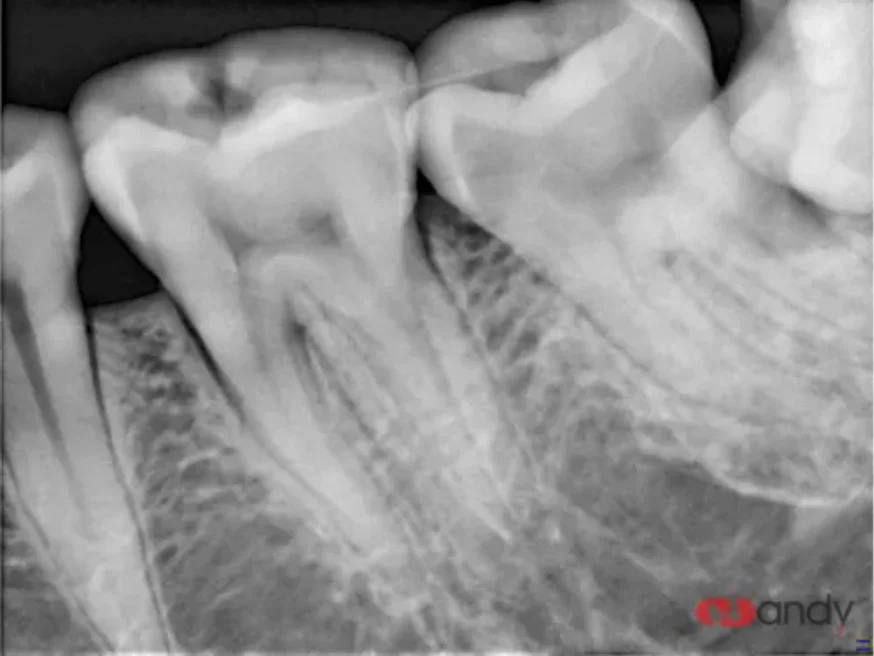 HDR 500A RVG датчик рентгеновского рентгена RVG стоматологический датчик
