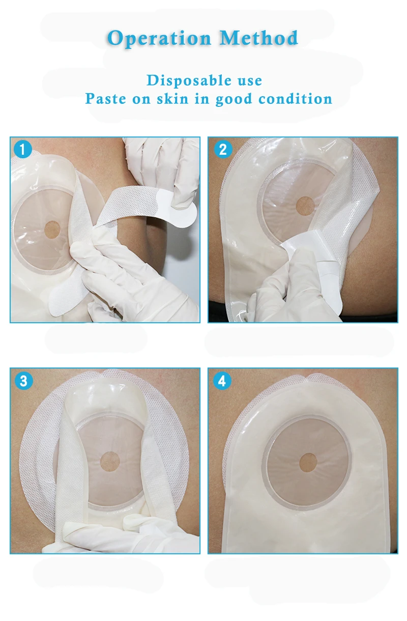 Stoma Ostomy Colostomy Ileostomy Urostomy Pouch Bag Accessories Leak