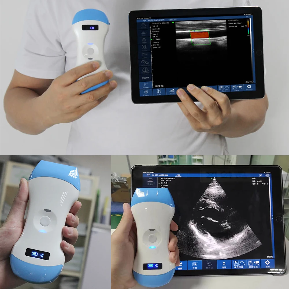 Compact Mobile Ultrasound With Convex Probe Featuring Ultrasound-on ...