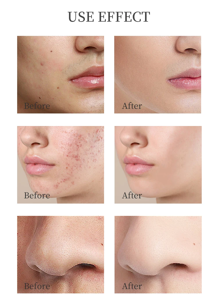 Amino Acid Moisturizingbubble Face Mask Deep Cleaning Oil Control Skin