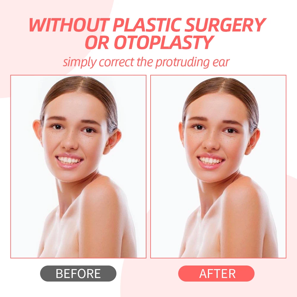 Popular Protruding Ear Corrector for Baby Ear Correction