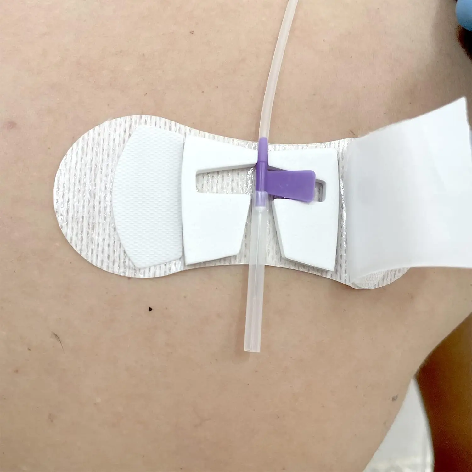 Sterile Adhesive Dressing for Fixing PICC Catheter EOS Disinfecting Type