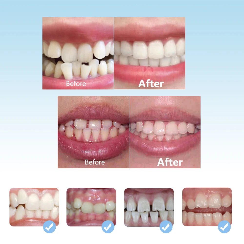 3 Stages Braces for Teeth Straightener Invisible Dental Orthodontic Brackets Dentistry Mouth Tray Alignment Caps Aligner