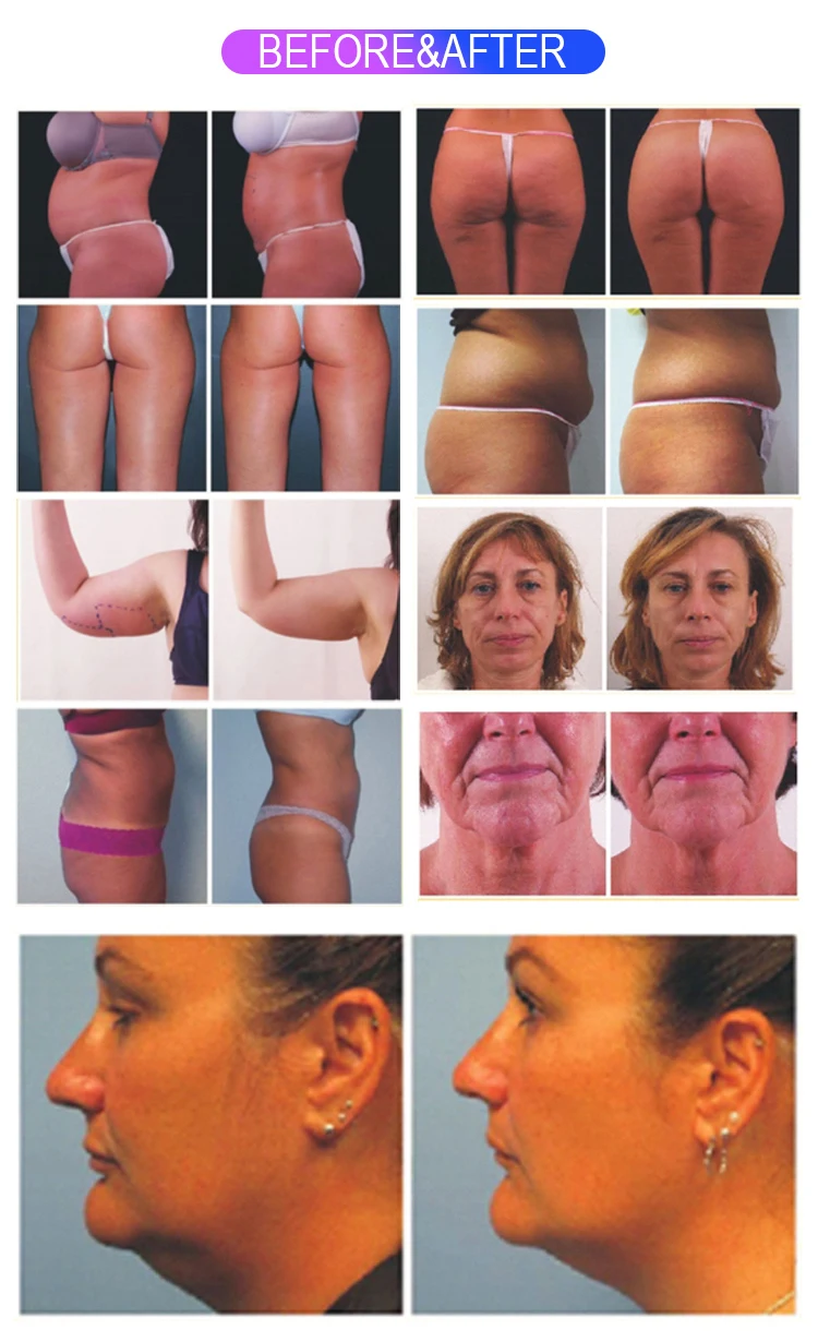 New  2 in 1 Ultra 360 Body Contouring Fat Removal Machine Facial Lift Wrinkle Slimming  Body Contouring Machine