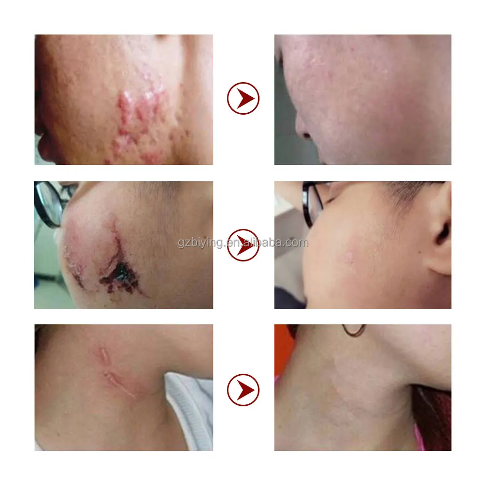 fastest-acne-scar-removal-cream-scar-gel-bruises-repair-cream-tummy