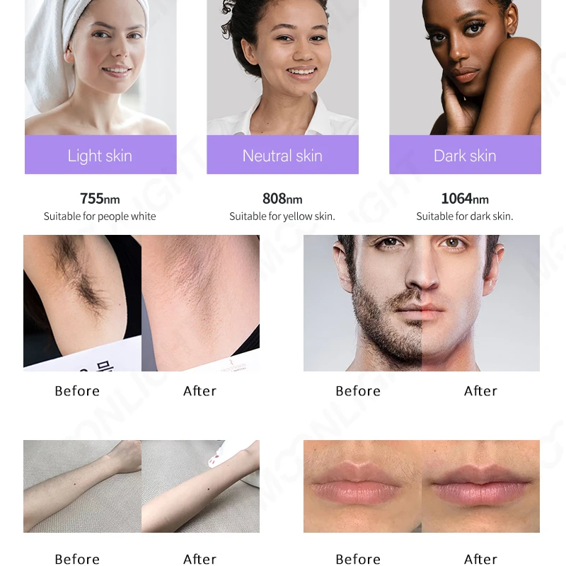 Smart Macro Channel Cooling Gel Fiber Optic Cables for Diode Laser Hair Removal Spark Pro Machine Beauty Equipment