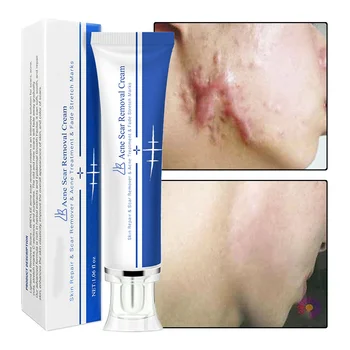 oem Strong Effective Acne Scar Removal Cream Pimples Stretch Marks Remove Face Gel Tummy Tuck Tightening Stretch Mark Removal Cr