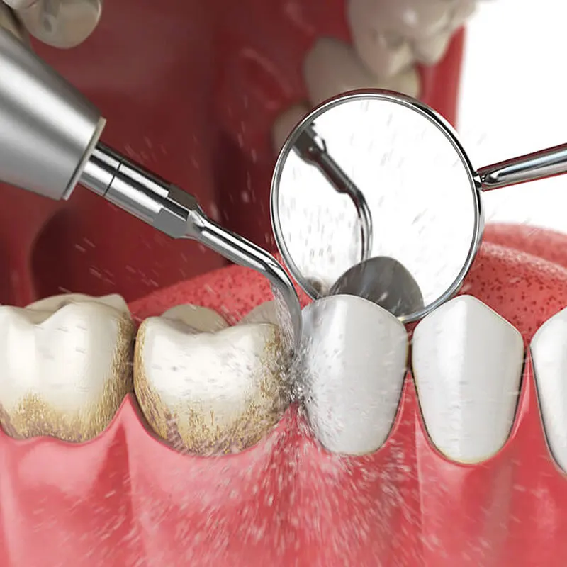 Профессиональная гигиена полости рта что это. Профгигиена полости рта air flow 2022. Профессиональная гигиена полости рта что это. Снятие зубного налета методом air flow. Профессиональная гигиена полости рта что это.