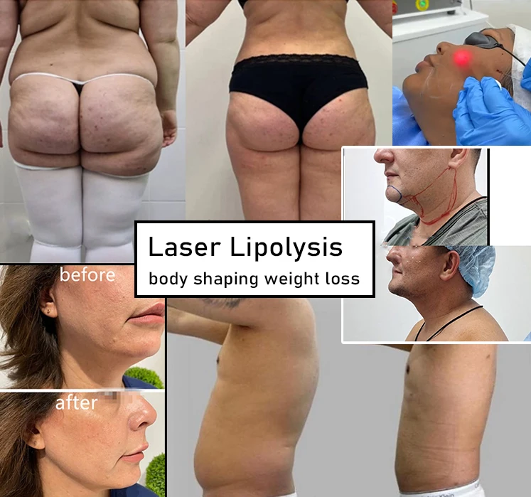 980 1470 Diode Laser Minimal Invasive Plastic Surgery Laser Liposuction Lipo Laser Slimming Endolaser Lift Machine