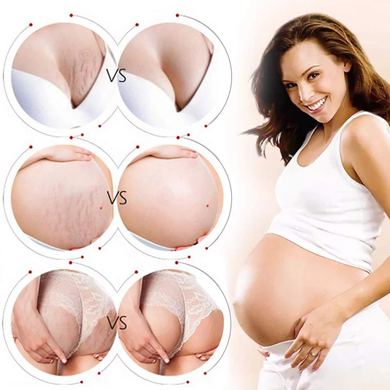 Частная этикетка растяжек шрамов крем для удаления беременности шрамы беременности и родам ремонт растяжек крем для лечения акне