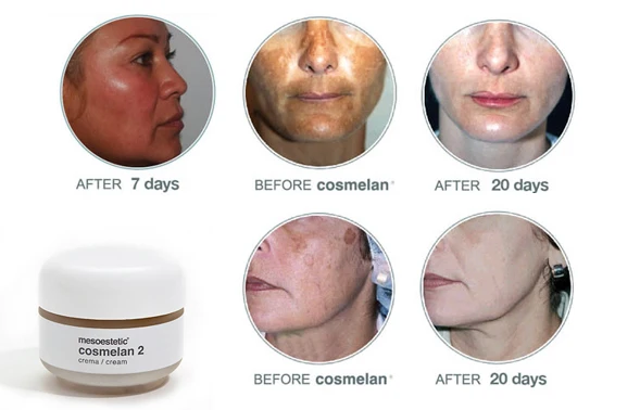 Spain Cosmelan2  Remove Accumulated Authentic  Promote Skin Cell Renewal