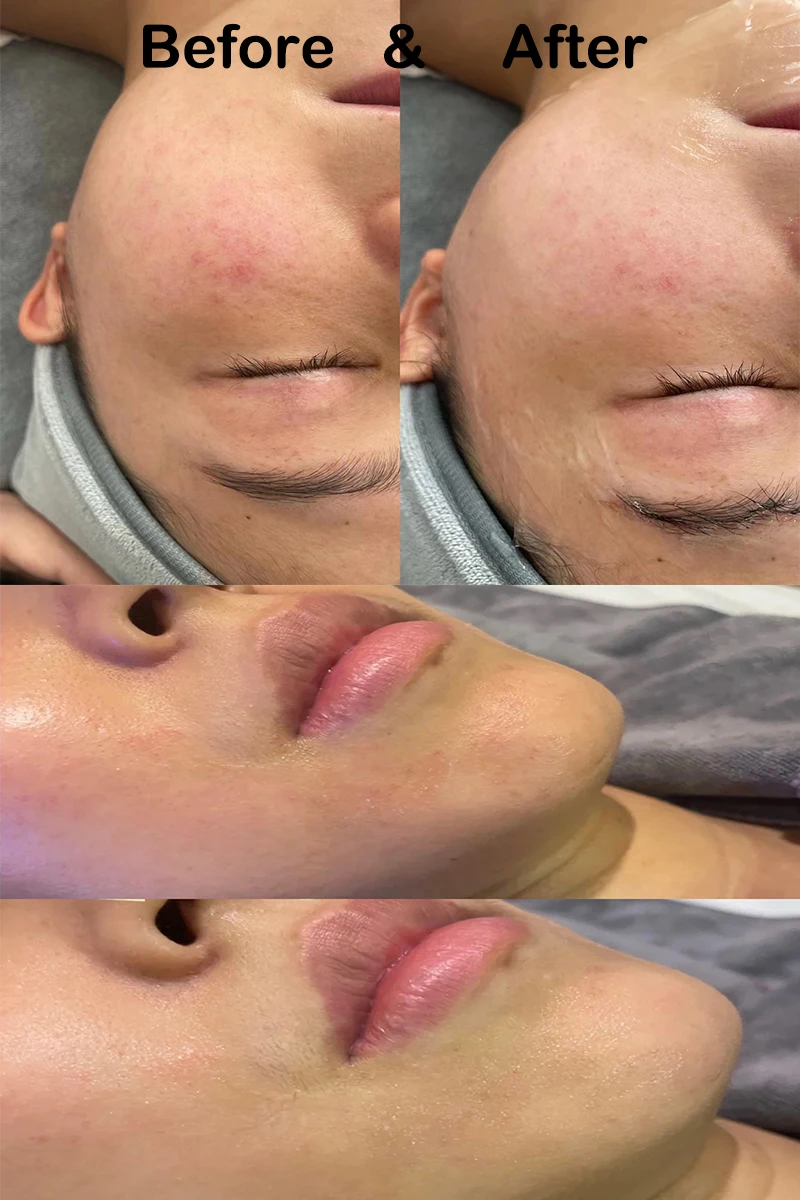 Description Picture 6 of itemFactory direct sales beauty machines for facial improvement, lifting and wrinkle removal, non surgical beauty equipment