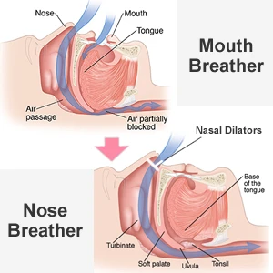 STOCK Set 8 Pcs Premium Stop Snoring Nose Vent Soft Silicone Anti Snore Nasal Dilator